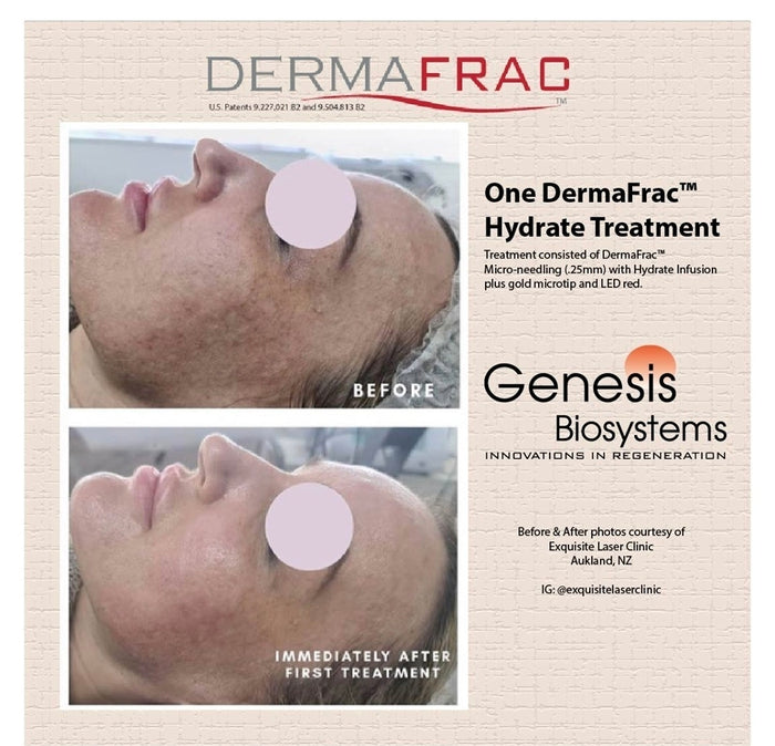 Exquisite Laser Clinic skin treatment Dermafrac 4 in 1 Skin Rejuvenation