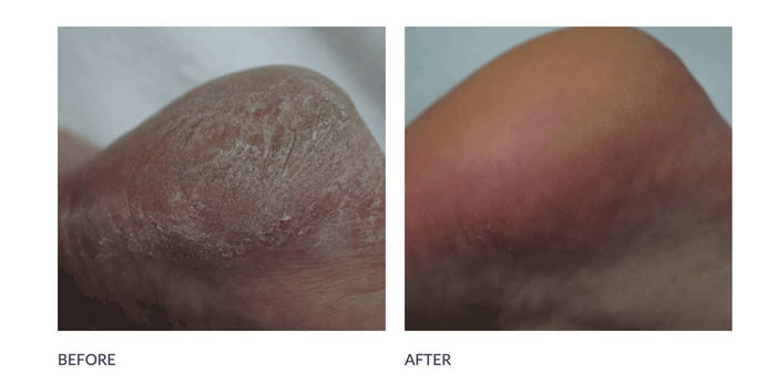Footlogix DD Cream Mousse, 125 ml Dry to Cracked Skin Foam Footlogix